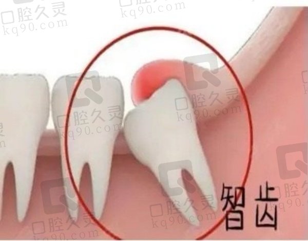 石家庄牙博士口腔拔智齿的优势
