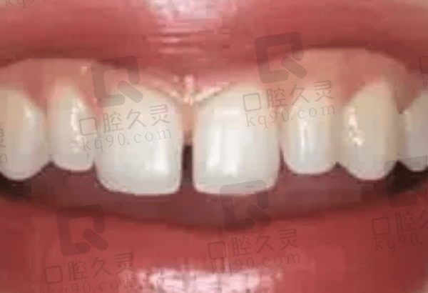 烤瓷牙缝隙产生的原因