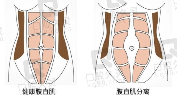 腹壁成形和腰腹吸脂有什么区别