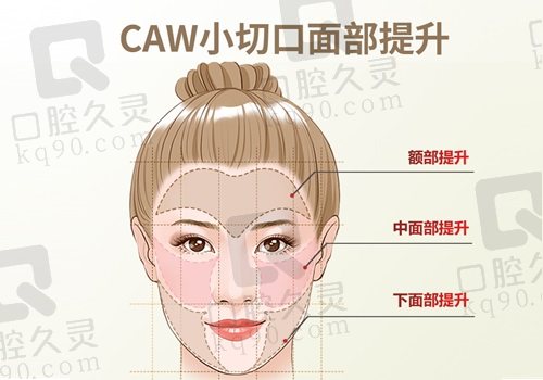 杜太超院长caw小切口面部拉皮提升术