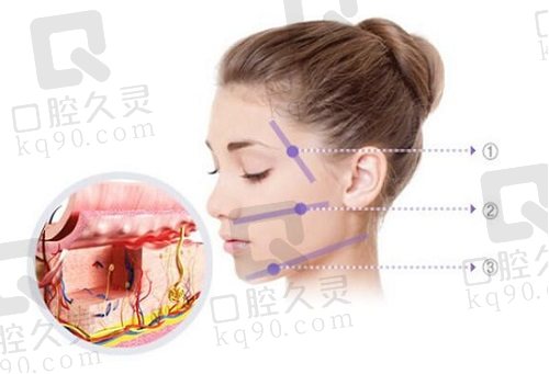 李晓东院长psv小切口面部拉皮提升术