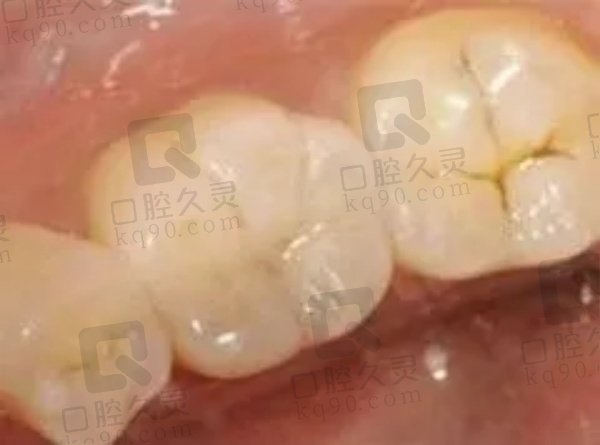 美国3M Z250树脂补牙的优势