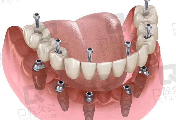 全口种植牙