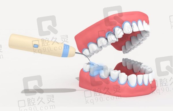 超声波洗牙的适用人群