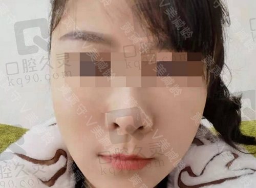 北京加减美v美减龄术后5个月