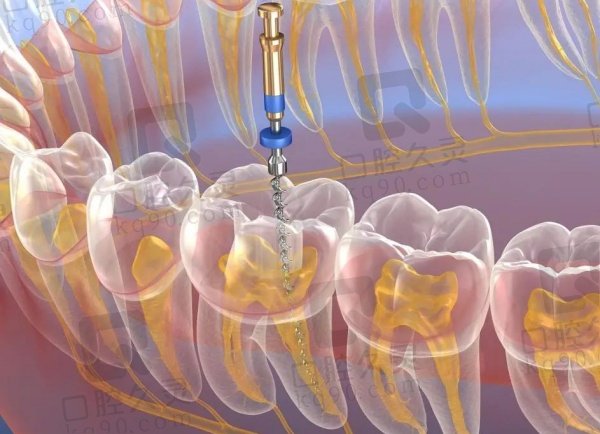 太原小苹果口腔医院根管治疗价格