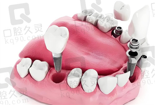 成都新桥口腔医院种植牙多少钱