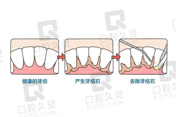 洗牙要抛光好还是不抛光好？