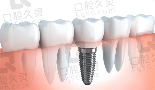 登腾和奥齿泰哪个好