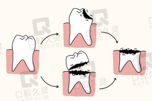 虫牙是拔牙好还是补牙好？