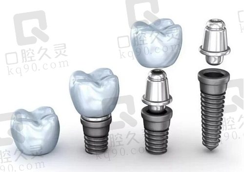 温州艺星口腔医院种植牙价格