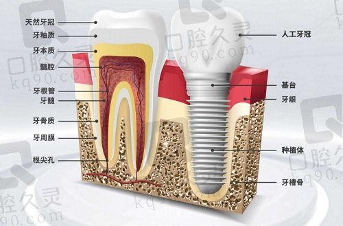 温州艺星口腔医院种植牙价格