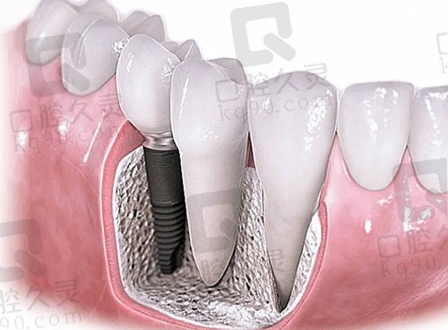 温州艺星口腔医院种植牙价格