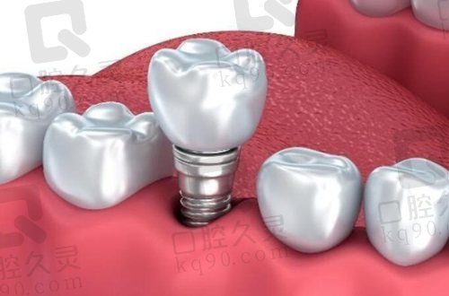温州艺星口腔医院种植牙价格