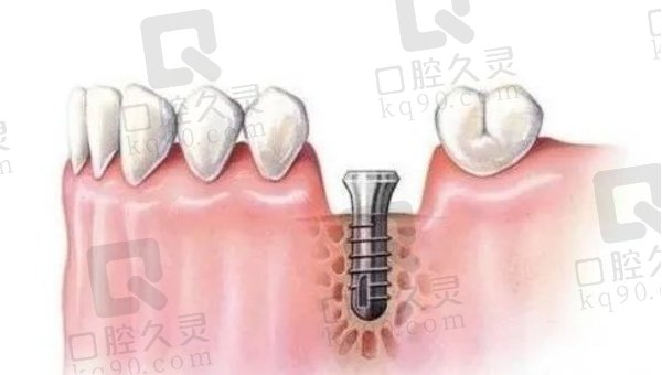 韩国登腾种植牙的特点