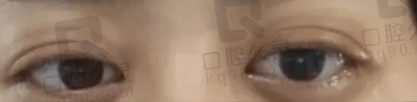 金华爱尔眼科医院ICL晶体植入手术的具体体验