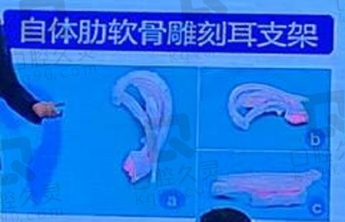 北京米兰柏羽丽都耳再造技术怎么样？