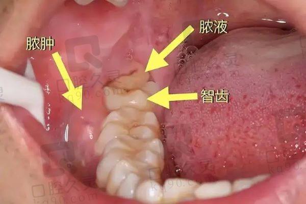 濰坊華貝口腔醫(yī)院拔牙價(jià)格