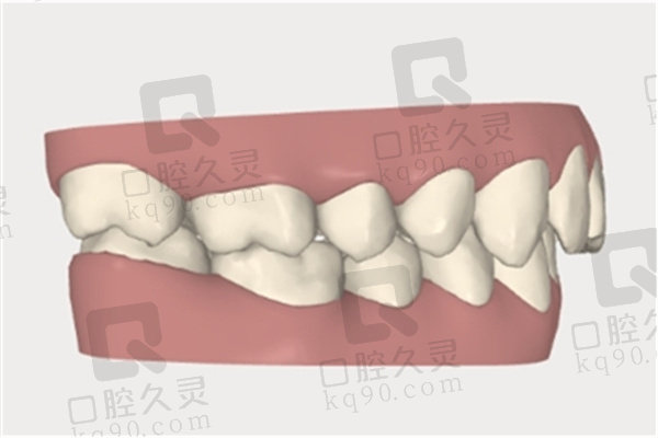 单侧咀嚼导致牙齿咬合不齐的原因及预防措施