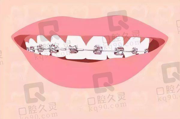 铜陵牙齿矫正多少钱