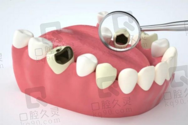 为什么选择美国3M Z350树脂补牙g