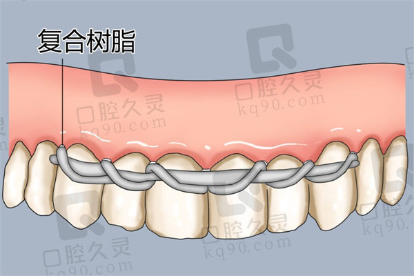 松动牙固定术是暂时的还是永 久的