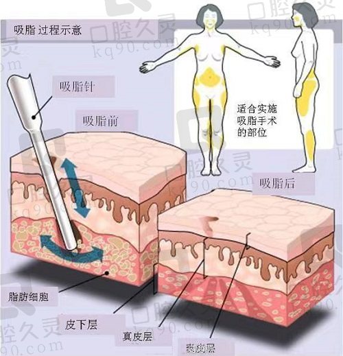 北京米兰柏羽丽都脂肪填充怎么样？