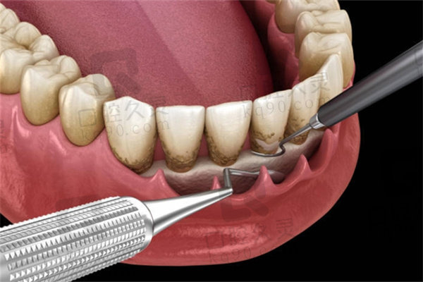 牙周翻瓣手术的利弊