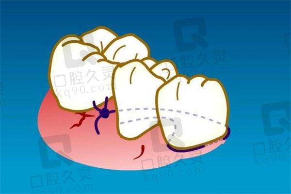 牙周翻瓣手术的利弊