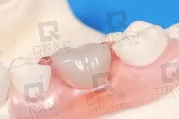 北京美冠塔口腔3Mz350树脂补牙89元起