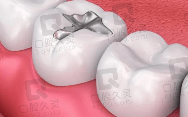 北京美冠塔口腔3Mz350树脂补牙怎么样？
