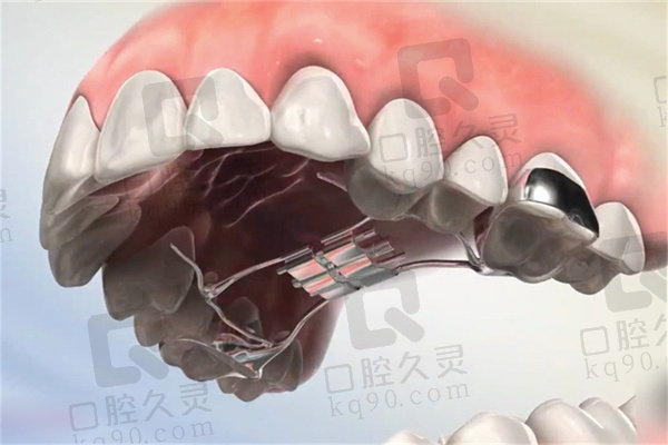 儿童扩弓矫正牙齿的利弊
