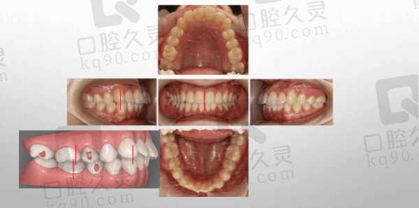 大连洁雅口腔初次就诊与佩戴隐形矫正器