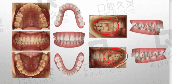 大连洁雅口腔矫正过程中的感受与变化