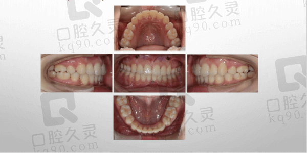 大连洁雅口腔牙齿矫正术后与使用情况