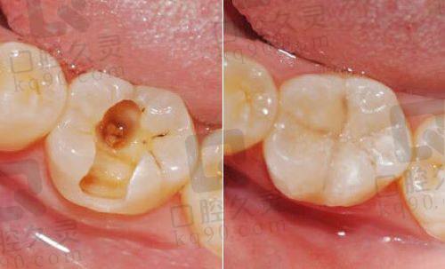 深圳雅贝康口腔补牙多少钱