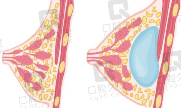 济南假体隆胸哪家好