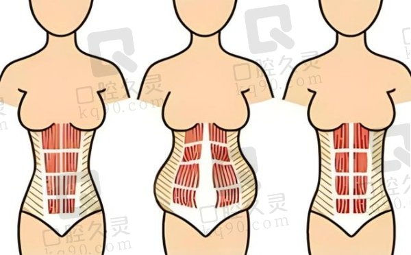广州紫馨做腹壁整形怎么样