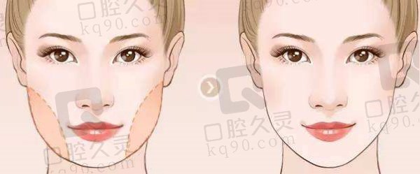 重慶安可忍醫(yī)生做輪廓技術(shù)好嗎