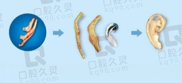 章庆国耳再造手术实例分享