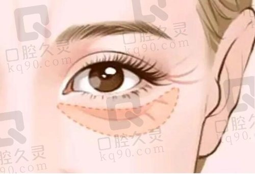 北京紫洁不开刀UM无痕去眼袋