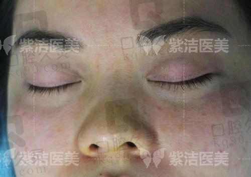 北京紫洁不开刀UM无痕去眼袋