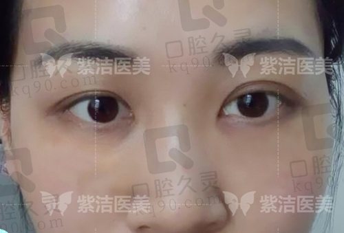 北京紫洁不开刀UM无痕去眼袋