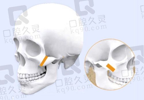 北京張笑天磨骨改善大嗎？