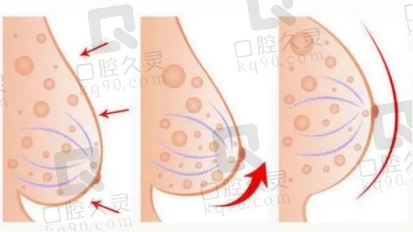 上海胸部下垂矫正医院哪家医院好