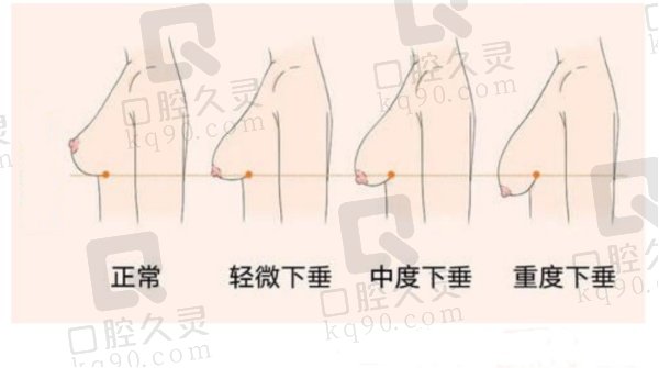 上海胸部下垂矫正技术超赞的医院