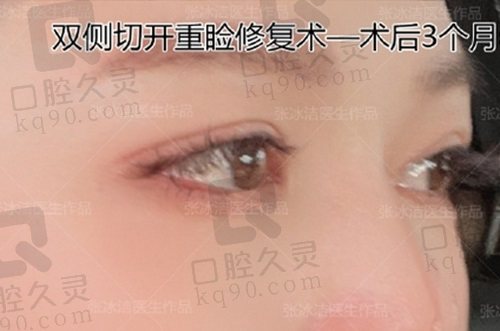 北京客莱美舍张冰洁眼修复