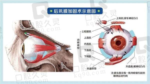 爱尔眼科做后巩膜加固手术能报销吗