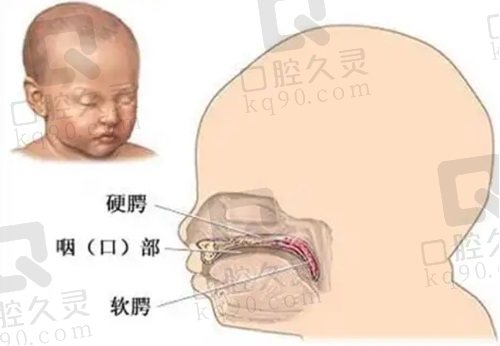 唇腭裂手术免费申请流程