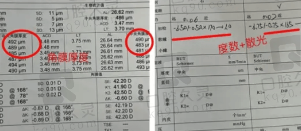 大连爱尔眼科医院ICL晶体植入手术实例分享